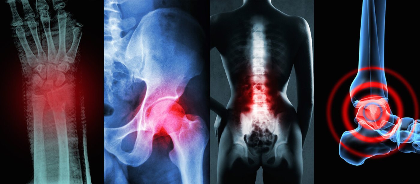 Artrosis y NoDol Curcuma para alivio del dolor articular